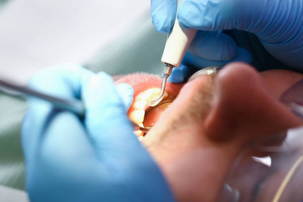Best Emergency Tooth Extraction in Shelby, NC